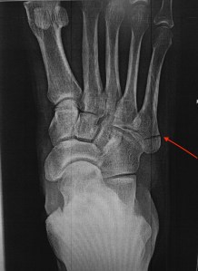 An X-ray of Tim's broken foot. So that you know he's not playing.